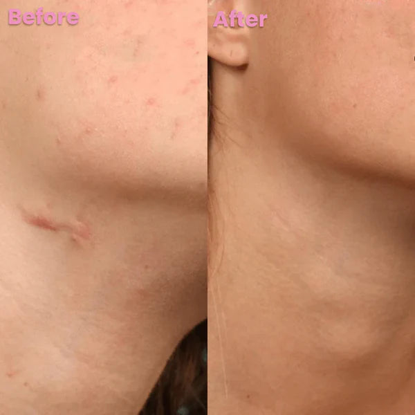 Dermasil Fita Cicatrizante